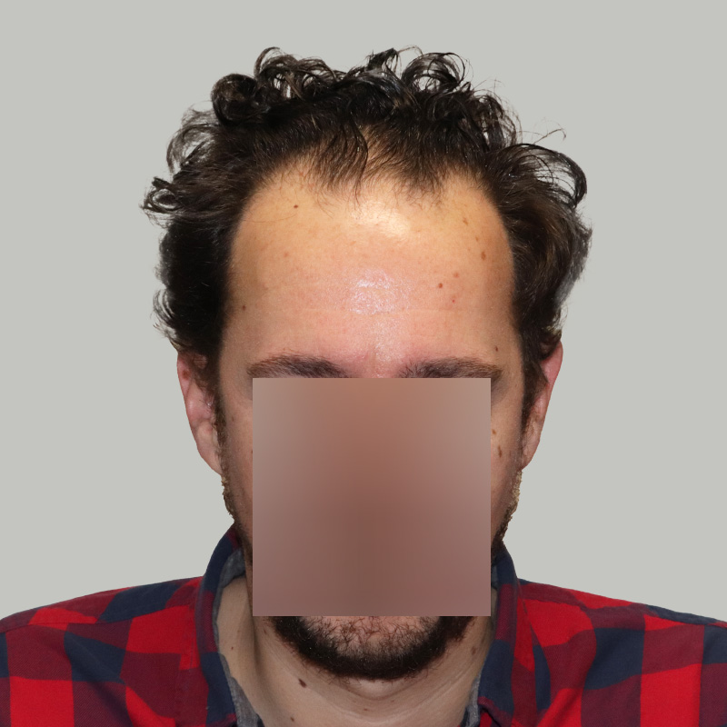 2176 FUE grafts - Front