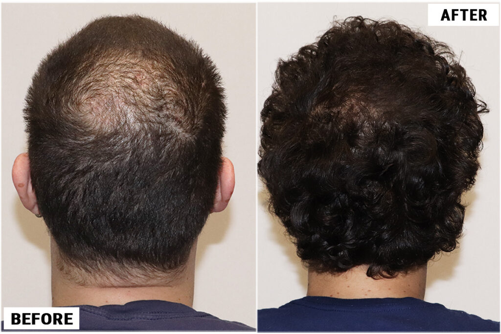 2176 FUE grafts - Back Donor