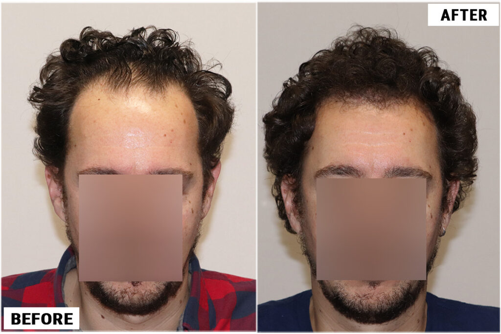 2176 FUE grafts - Front