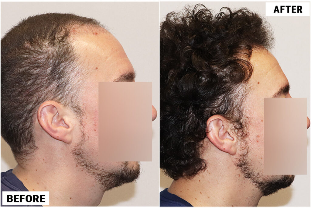 2176 FUE grafts - right