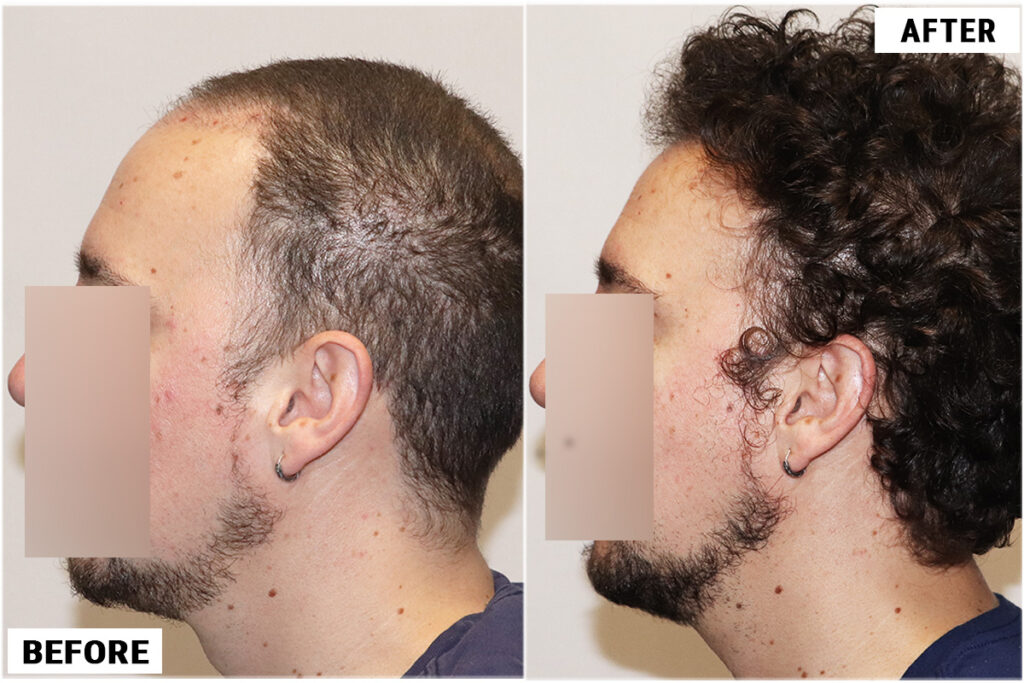 2176 FUE grafts - Right