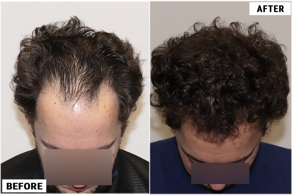 2176 FUE grafts - Top