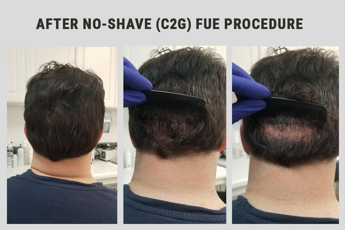 Patient after no-shave fue procedure