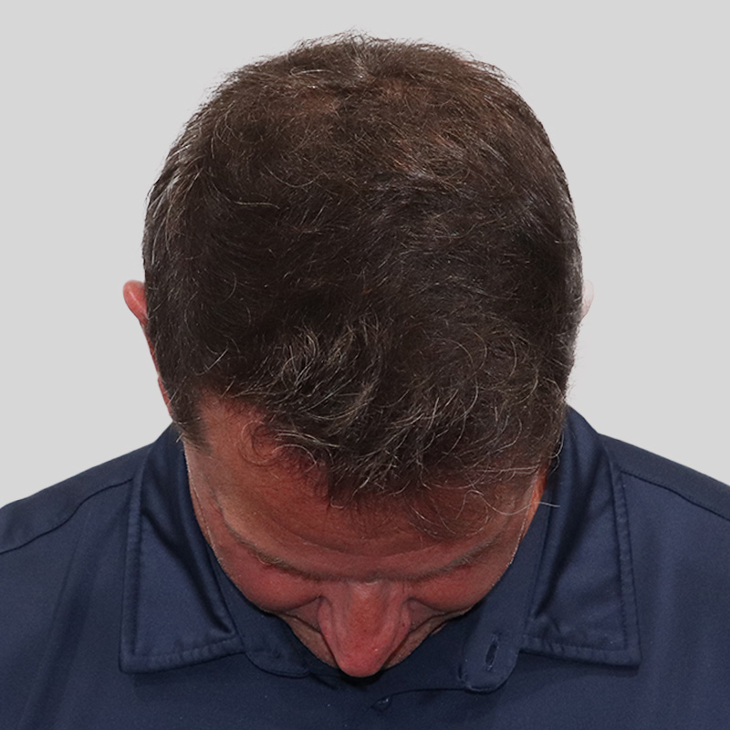Hair Transplant 1929 grafts FUE featured