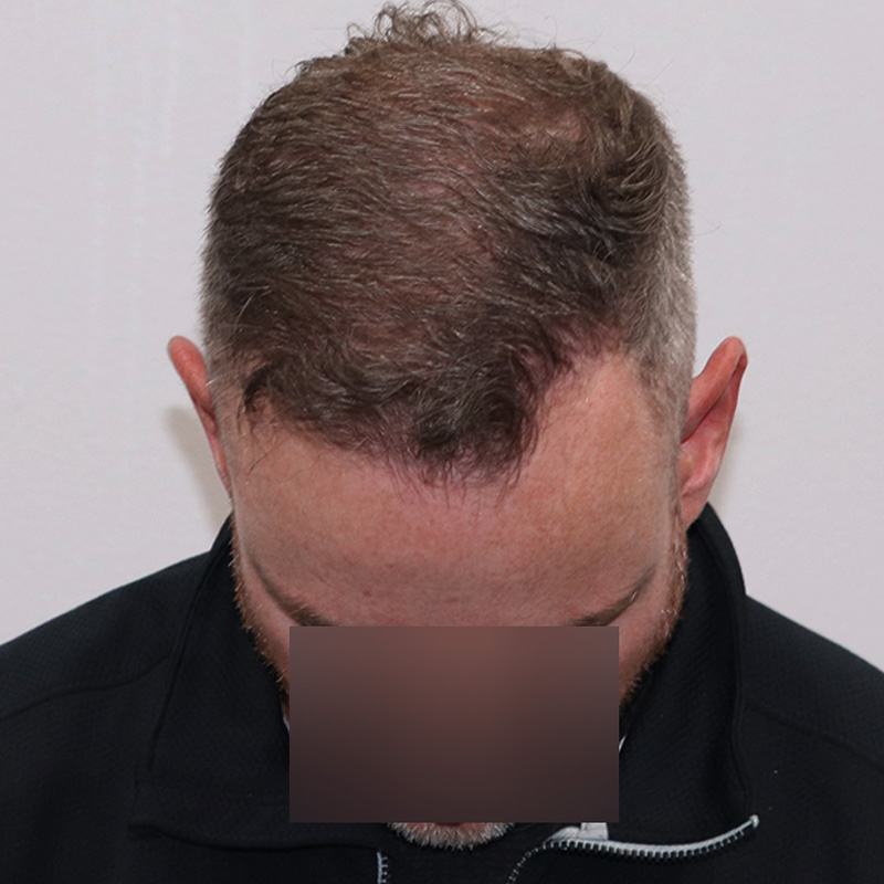 4116 fue before & after front