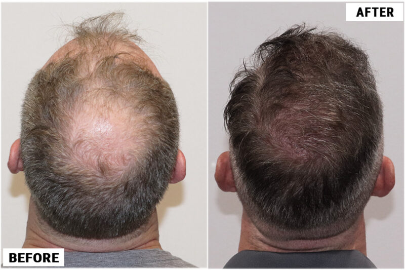 4116 fue before & after back