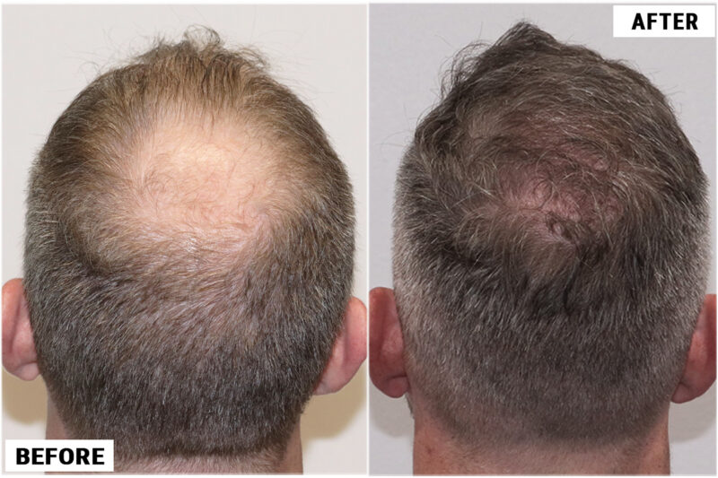 4116 fue before & after crown