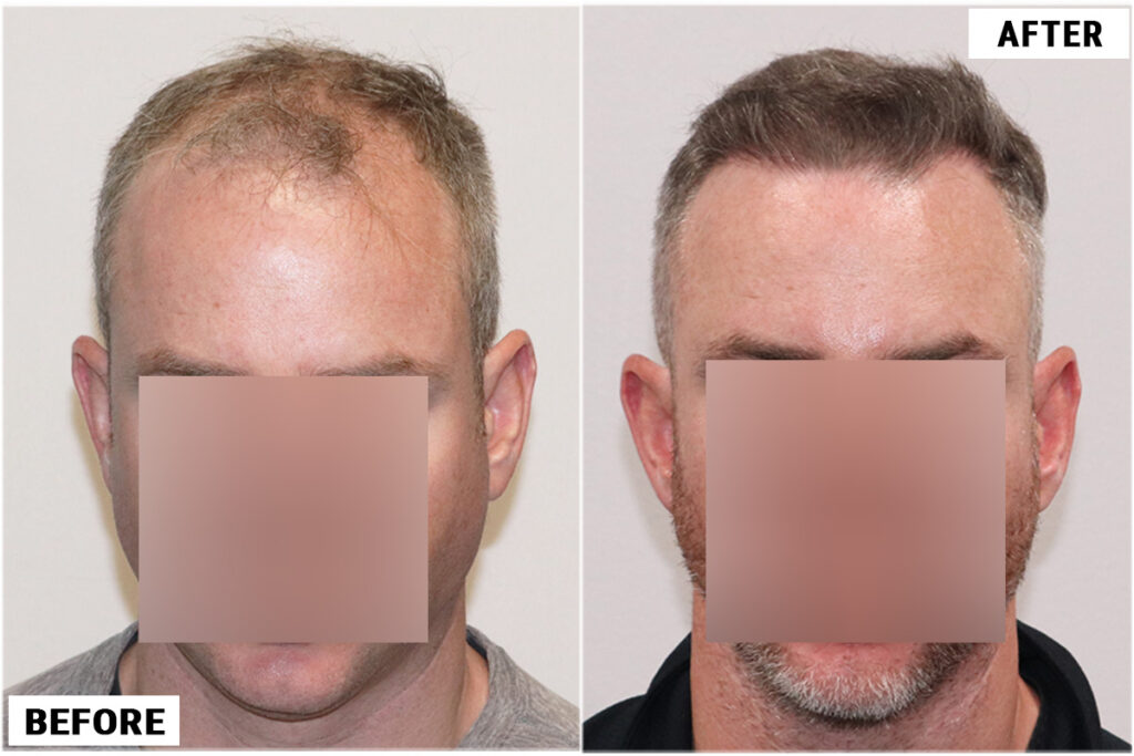 4116 fue before & after front