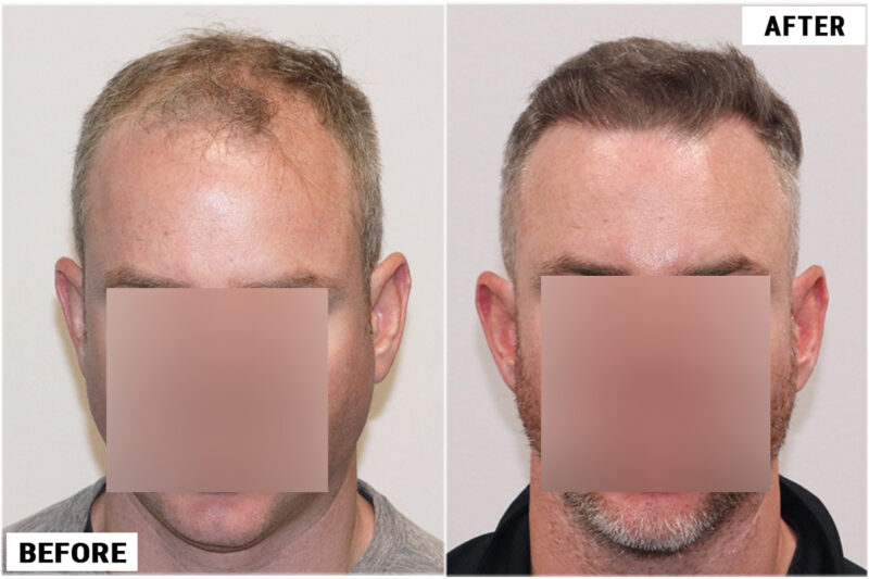 4116 fue before & after front