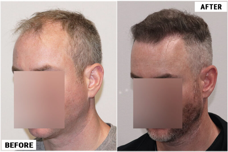 4116 fue before & after left