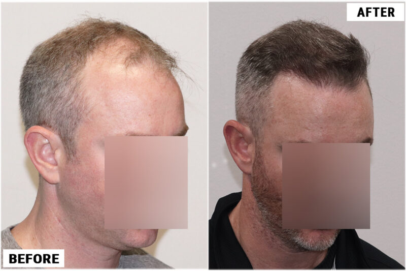 4116 fue before & after right