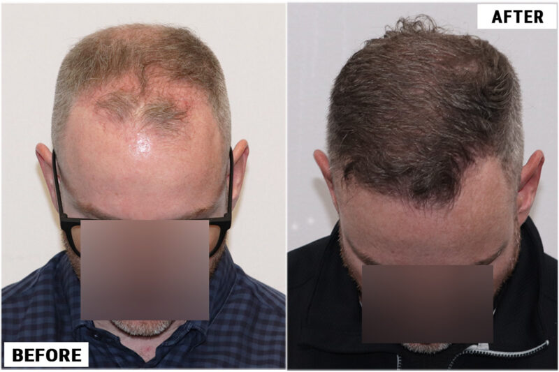4116 fue before & after top