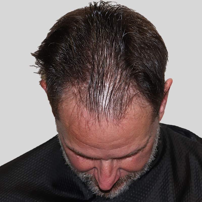 Hair Transplant 1929 grafts FUE featured