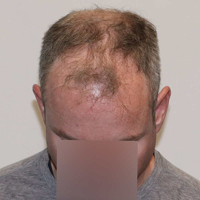 4116 fue before & after front