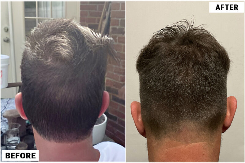 1920 FUE grafts results - donor back