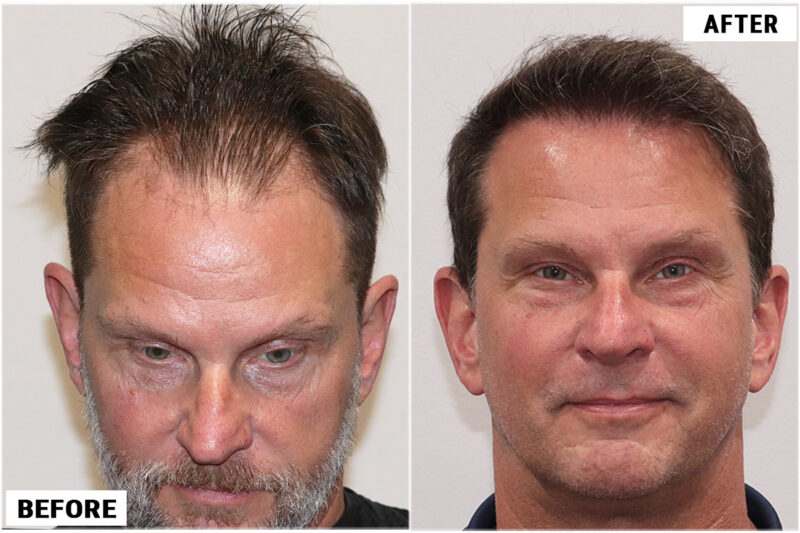 1920 FUE grafts results - front