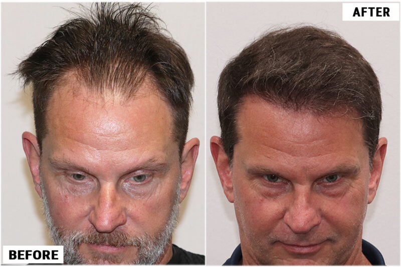 1920 FUE grafts results - front 2