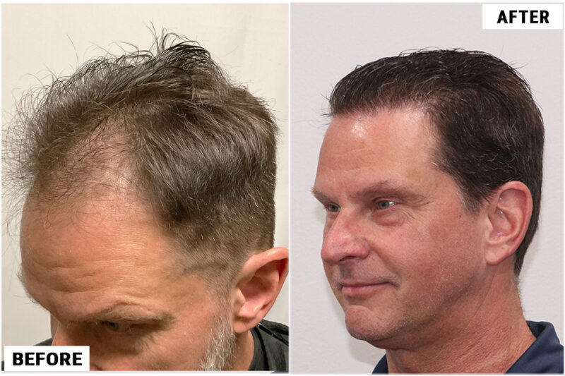 1920 FUE grafts results - left