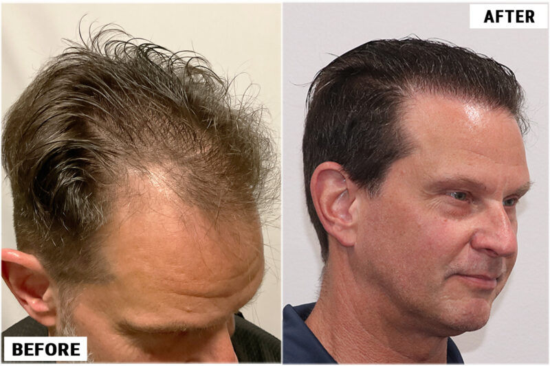 1920 FUE grafts results - right