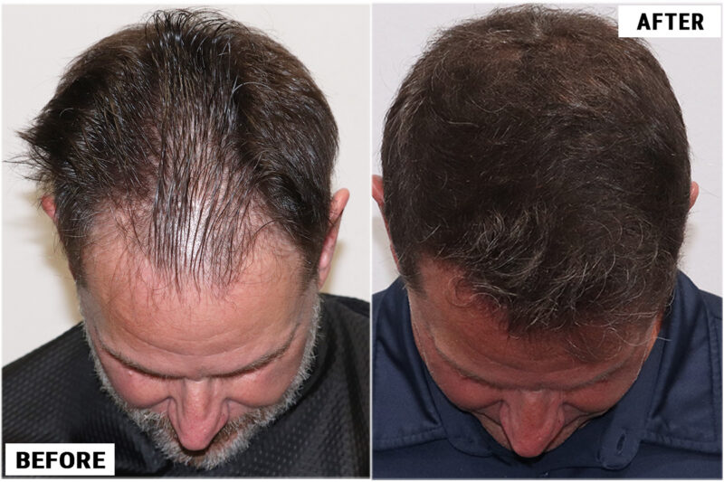 1920 FUE grafts results - top