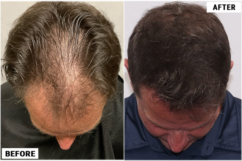 1920 FUE grafts results -top 2