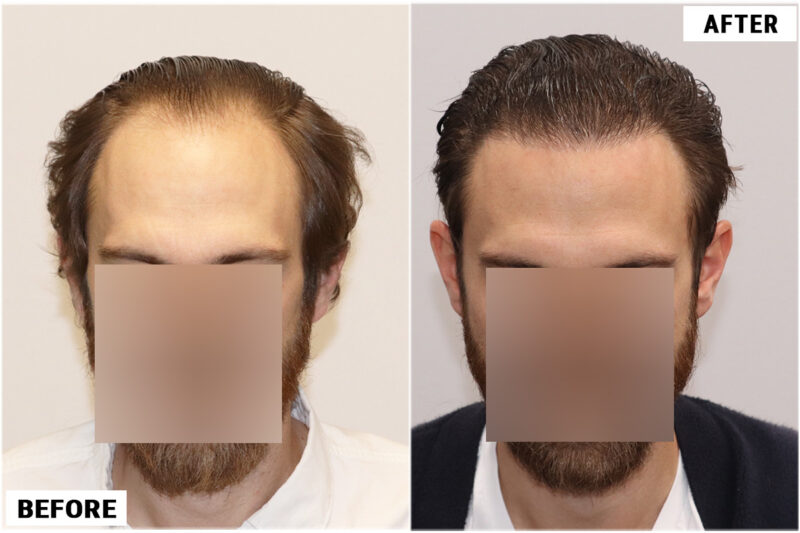 FUE before & after photo front