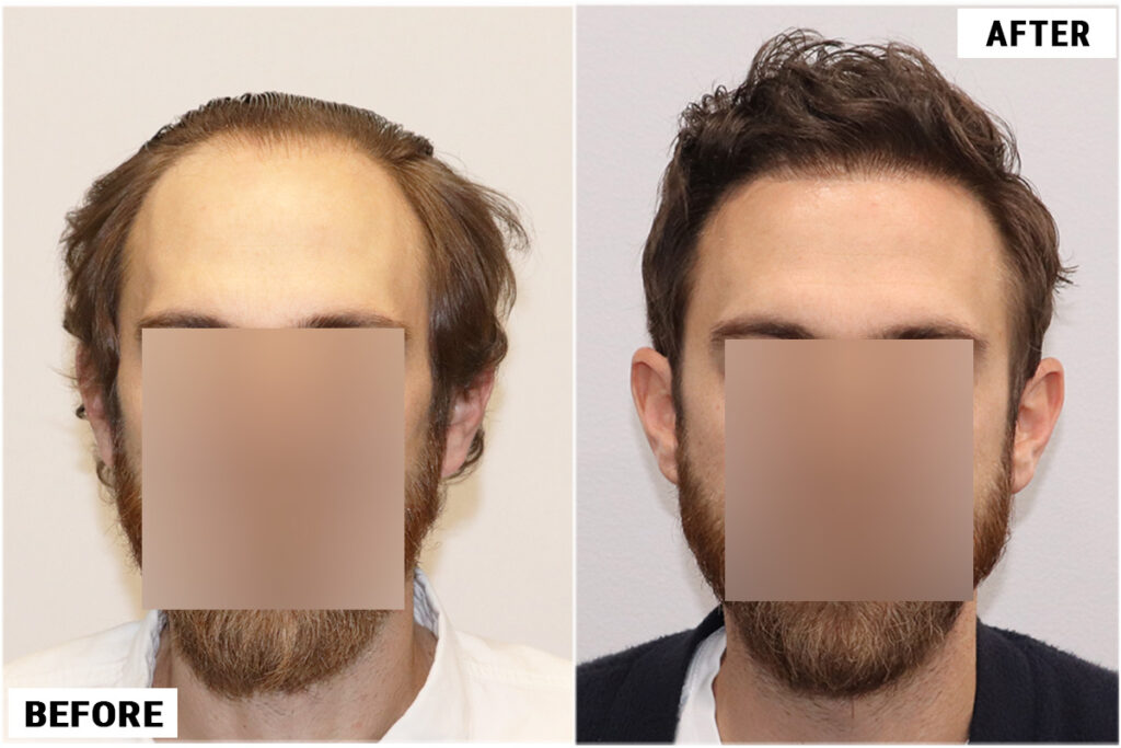 FUE before & after 2961 grafts - featured