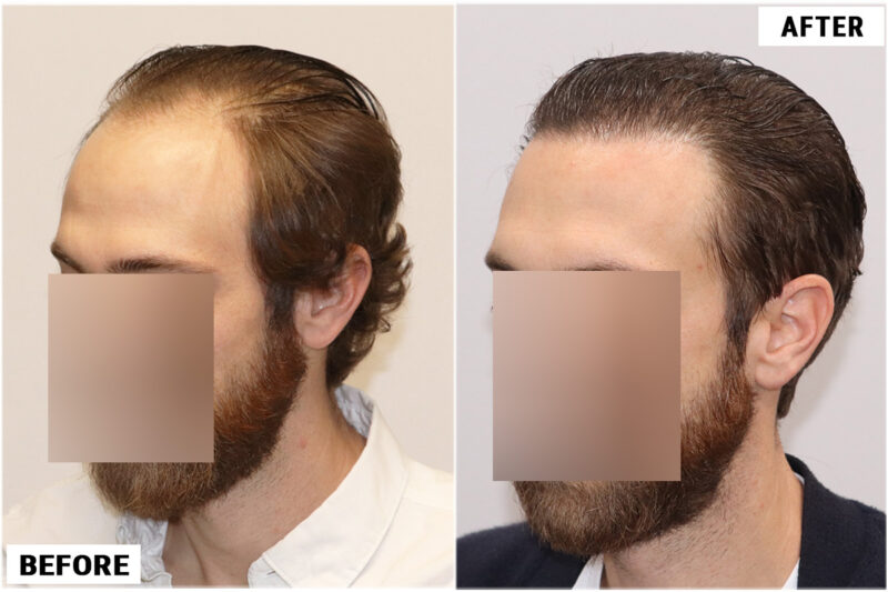 FUE before and after photo -left