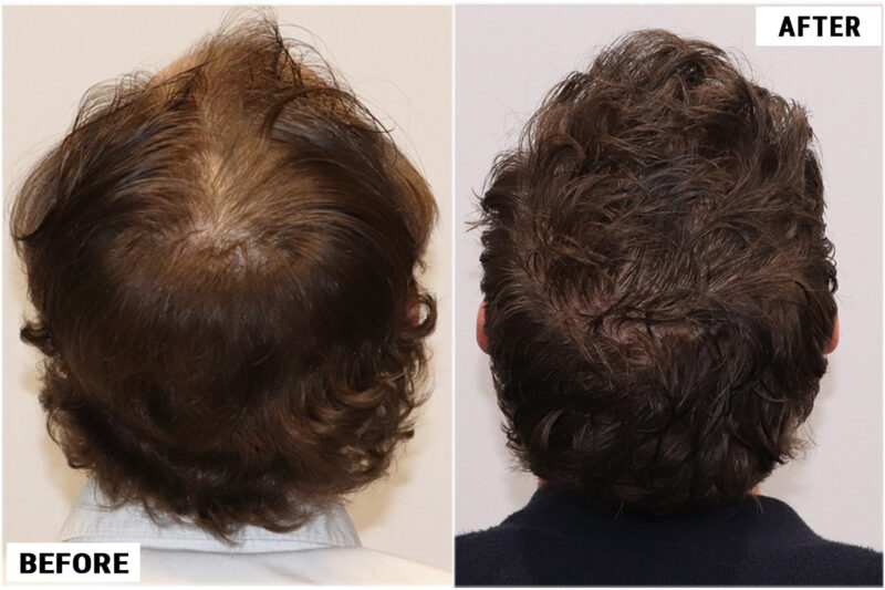 FUE before and after photo -crown