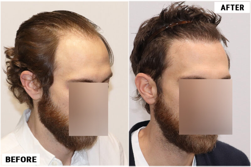 FUE before and after photo -right