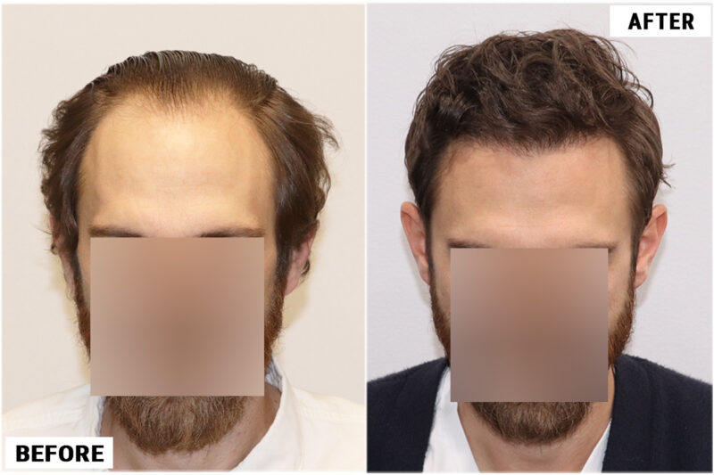 FUE before and after photo -top 2