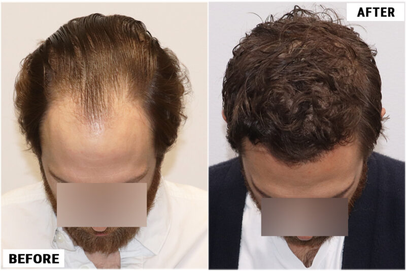 FUE before and after photo -top3