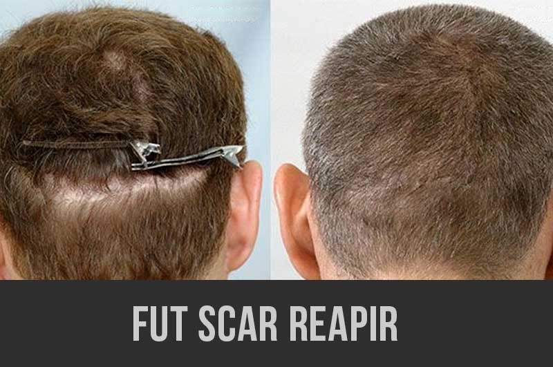 FUE scar grafting repair results