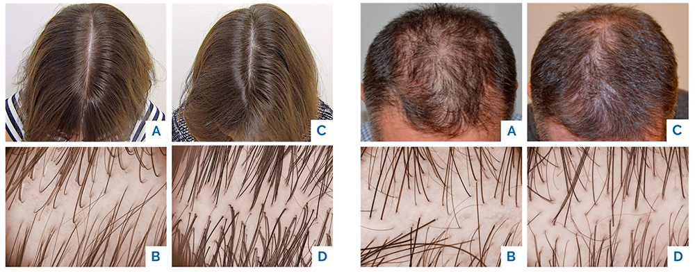 Tricopt before & after results female