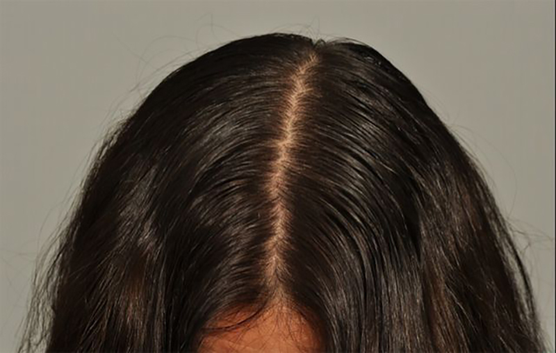 After CRP treatment top