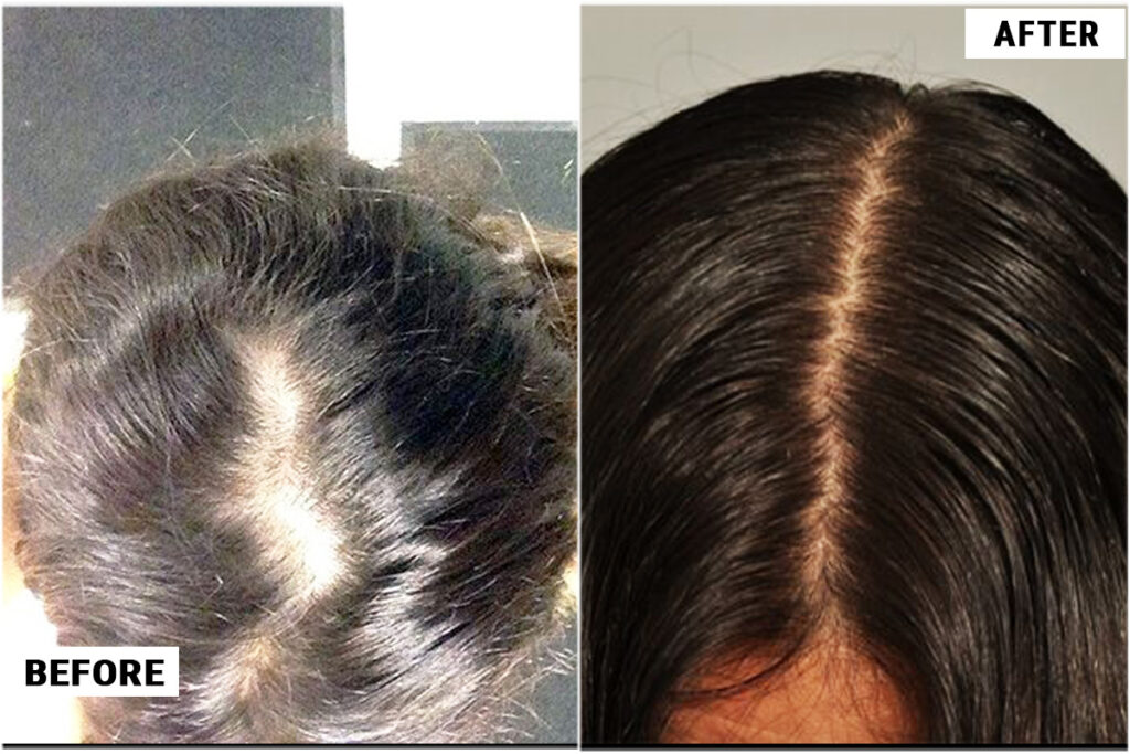 before and after CRP treatment on woman