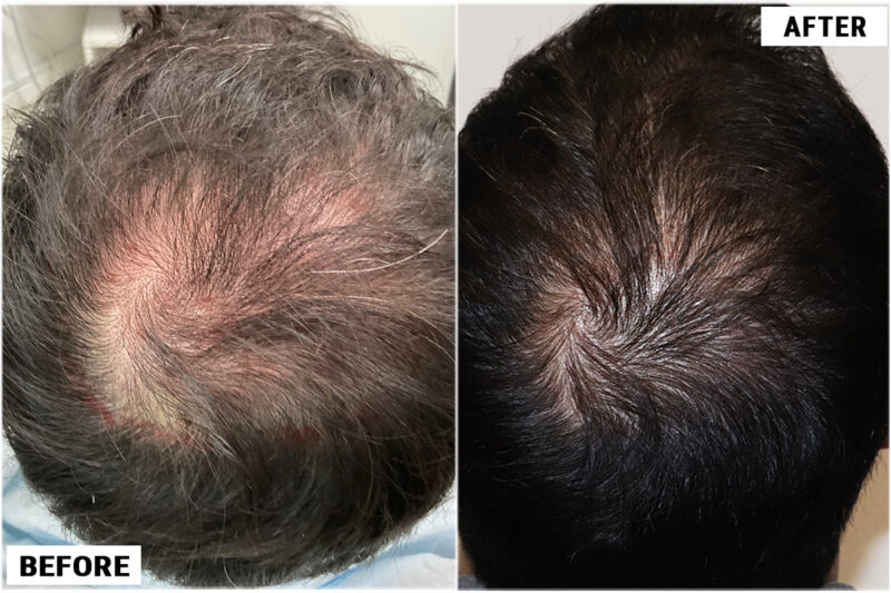 CRP #5 before and after crown 1