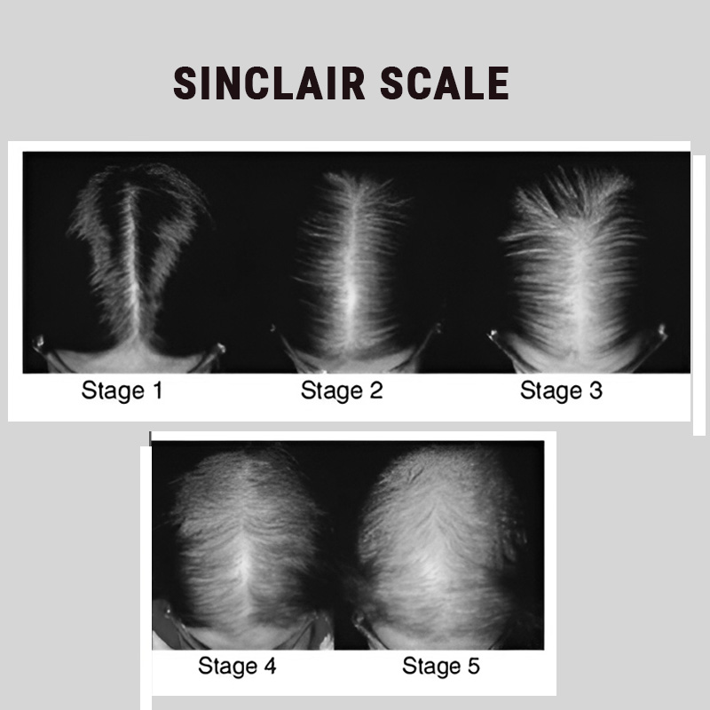 Sinclair scale hair loss