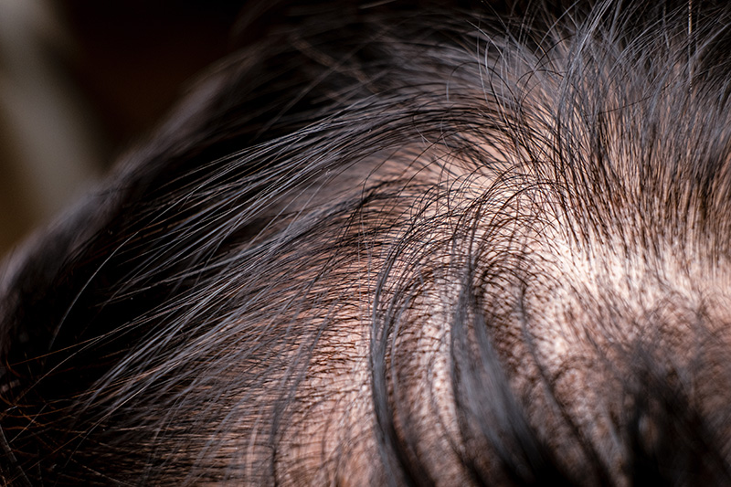 Hair thinning on the crown