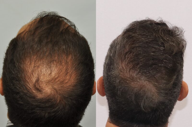 FUE 701 grafts crown 1