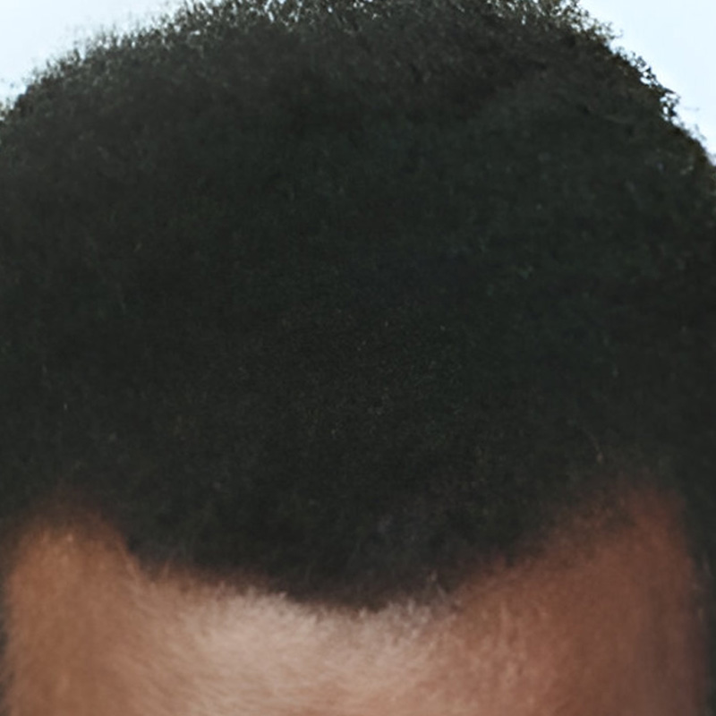 Hair transplant 400 grafts FUE featured