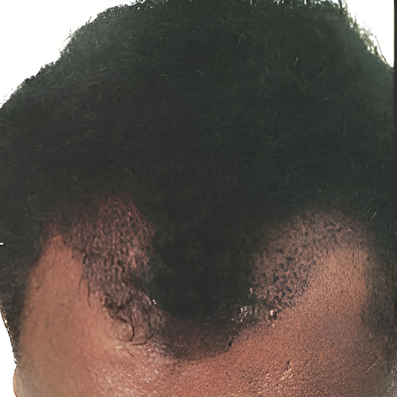 Hair transplant 400 grafts FUE featured