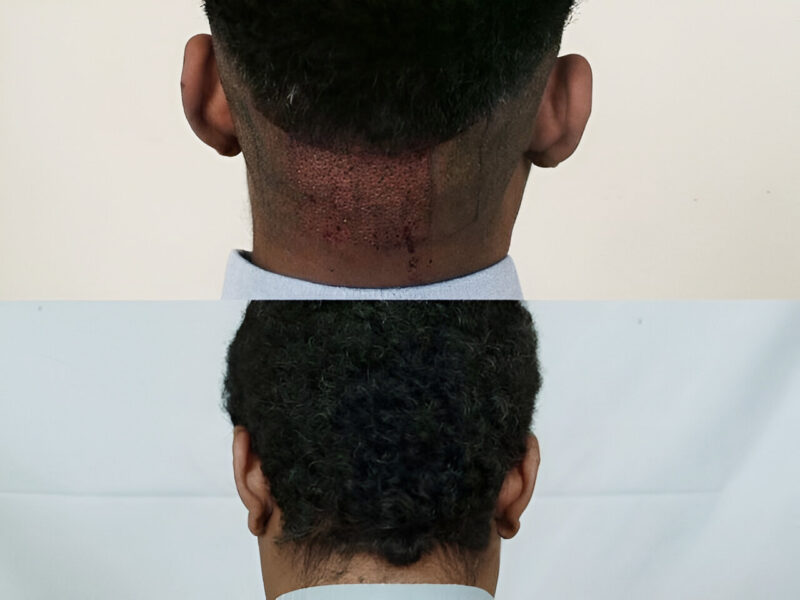FUE 400 grafts donor
