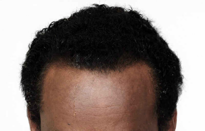 FUE 400 grafts after hairline