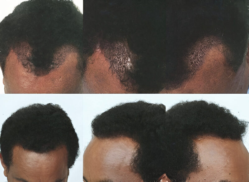 FUE 400 grafts Comparison