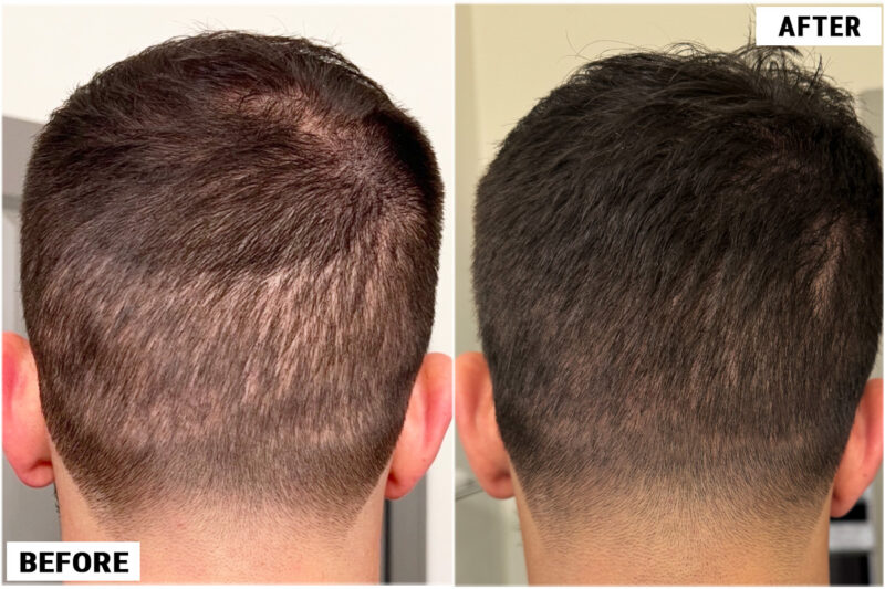 FUE plug removal #4 donor area