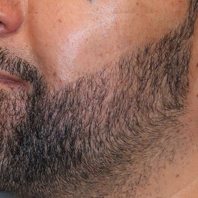 FUE beard featured