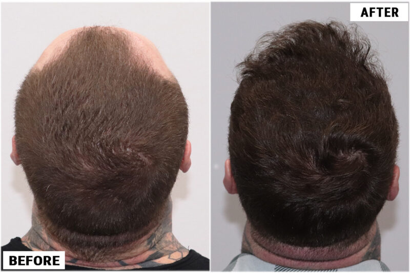 Hair transplant 1661 grafts FUE crown