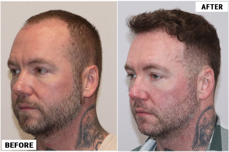 Hair transplant 1661 grafts FUE left