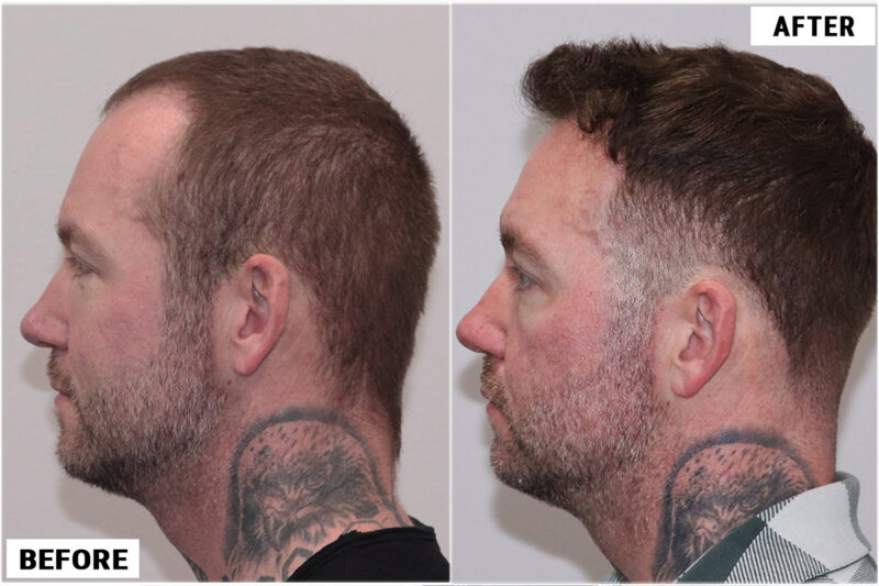 Hair transplant 1661 grafts FUE left #2